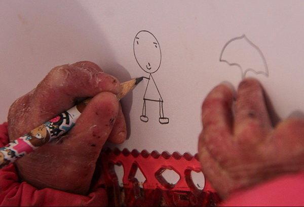شناسایی 332 نوع بیماری نادر در کشور شناسایی 332 نوع بیماری نادر در کشور