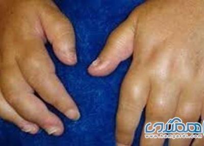 5 دلیل برای اینکه دست هایمان ورم می نماید